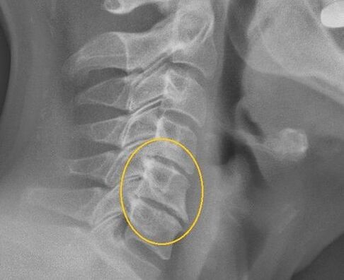 Emakakaela lülisamba osteokondroos x -ray